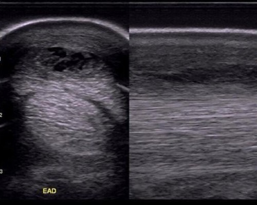 17-eco-tendinitis-tdfs
