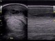 17-eco-tendinitis-tdfs