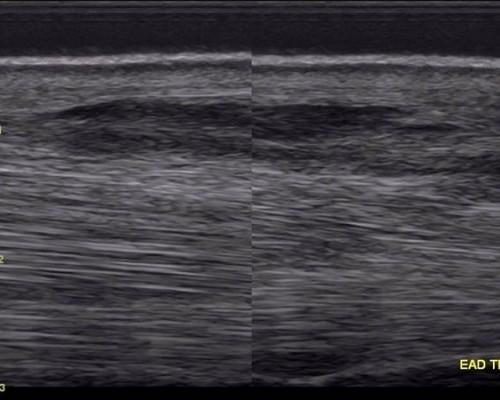 32-tendinitis2
