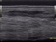 32-tendinitis2